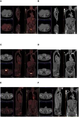 18F-FDG PET/CT Imaging: Normal Variants, Pitfalls, and Artifacts Musculoskeletal, Infection, and Inflammation